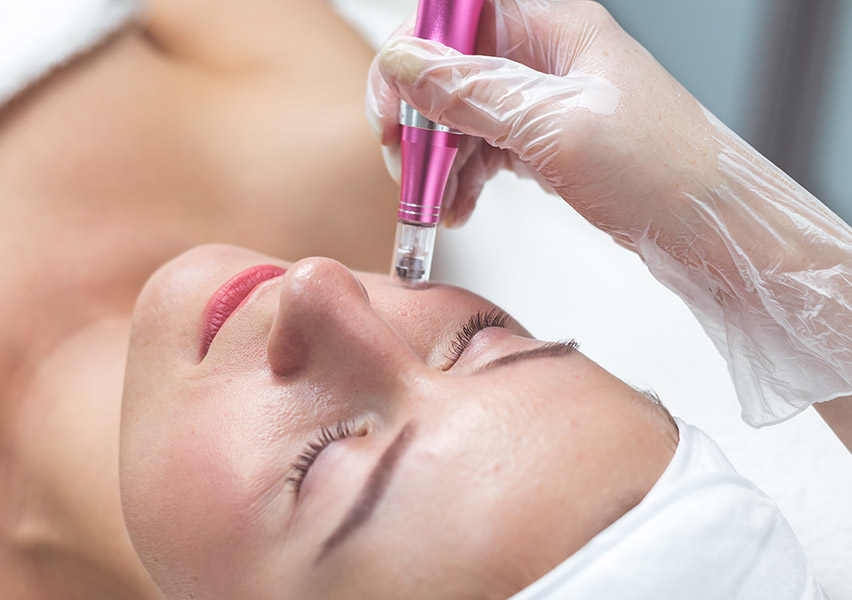 Microneedling Gesichtsbehandlung Lashes and Beauty by Ari in Bern, Schweiz